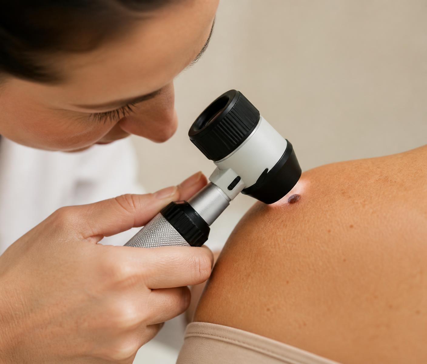 Dermatologista examinando uma lesão cutânea com instrumento óptico